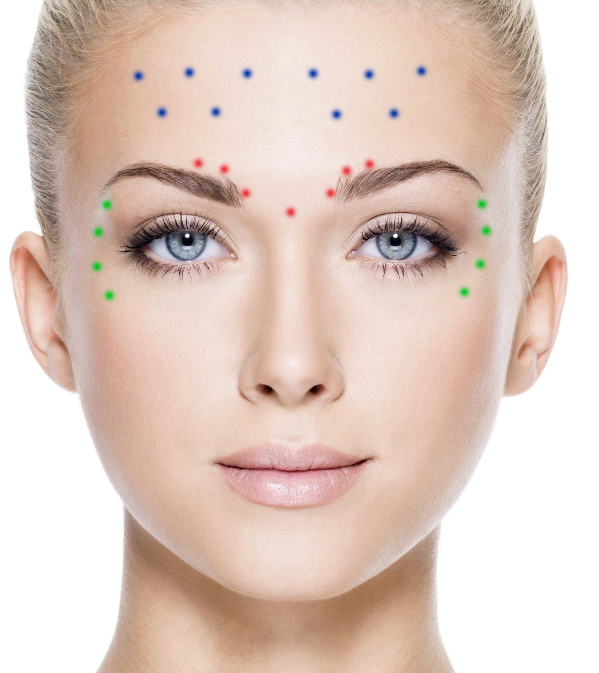 botox 1 zone prijs